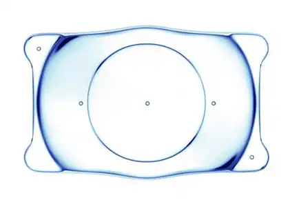 Implant phake EVO Lens Spheric pour la correction de la myopie par un chirurgien de la vision à Montpellier