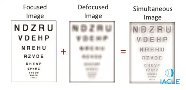 Vision d'un porteur de lentilles souples multifocales à différentes distances